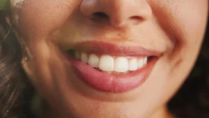 West Fargo woman after teeth repair with dental bonding