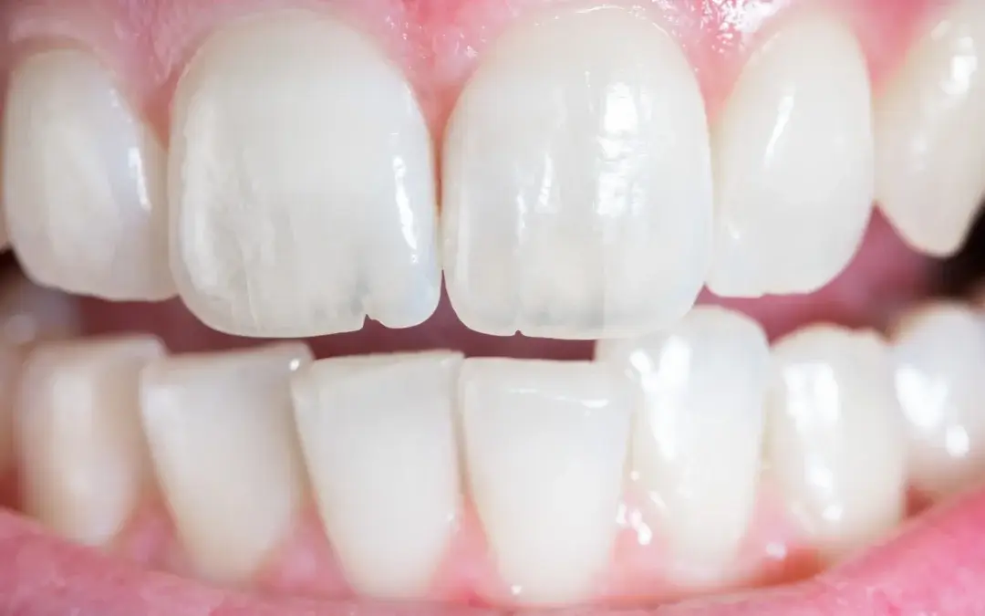 The Affordable Secret to a Stunning Smile