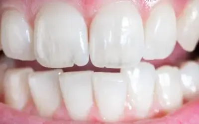 The Affordable Secret to a Stunning Smile