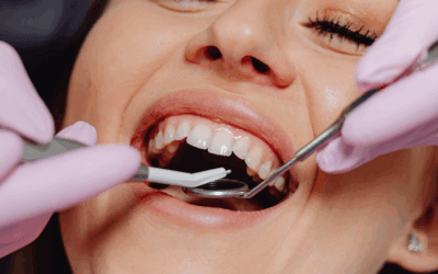 Say Goodbye to Smile Flaws with Dental Bonding