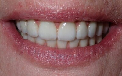 Confidence Begins with a Stunning Smile