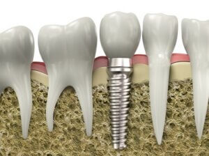 A graphic image of a dental implant placed in a jawbone, an example of Fargo smile restoration.