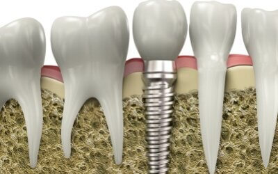 Dental Implants: The Complete Smile Comeback