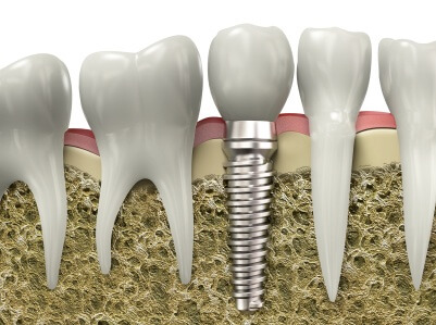A graphic image of a dental implant placed in a jawbone, an example of Fargo smile restoration.