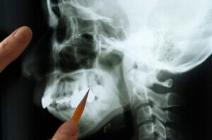 An x-ray of a jawbone being examined in an emergency dentistry situation in Fargo.