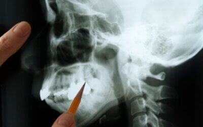 Don’t Ignore It: When Dental Injuries Turn Urgent