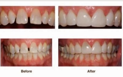 Want a New Smile Fast? Consider Porcelain Veneers