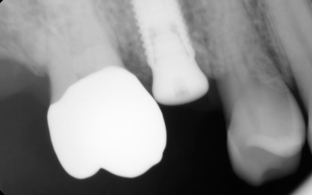 An x-ray of a dental implant placed in a Fargo area patient.