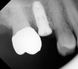 An x-ray of a dental implant placed in a Fargo area patient.